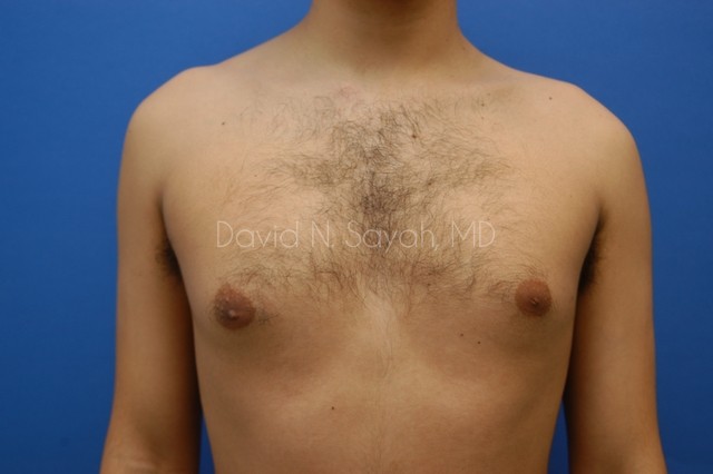 Liposuction Before and After | Sayah Institute