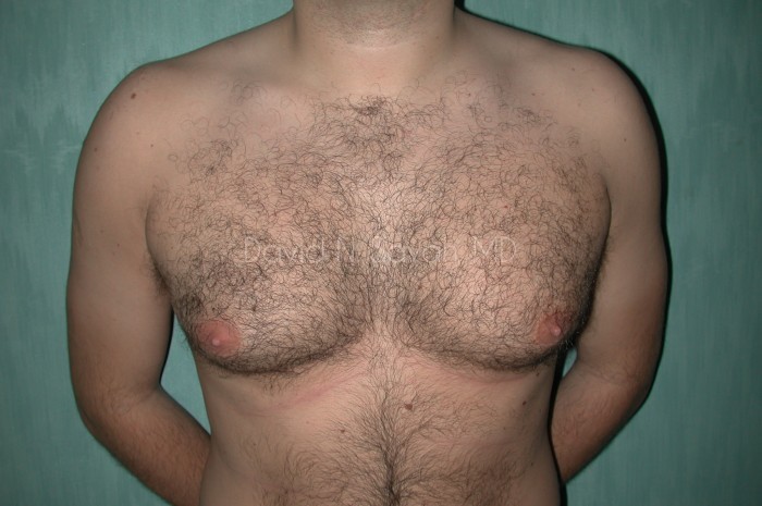 Liposuction Before and After | Sayah Institute