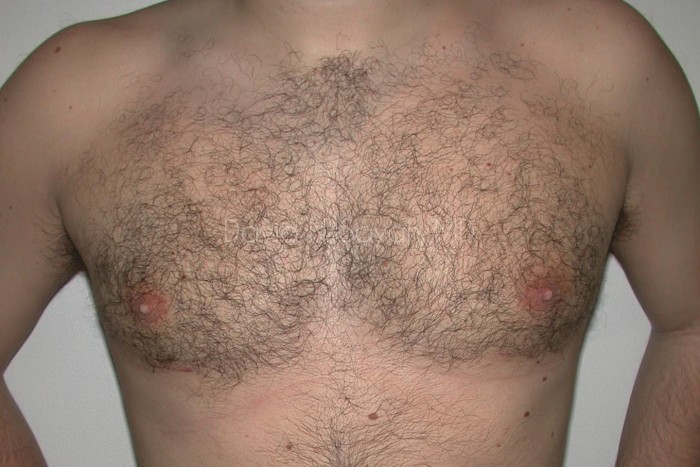 Liposuction Before and After | Sayah Institute