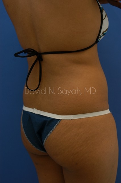 Liposuction Before and After | Sayah Institute