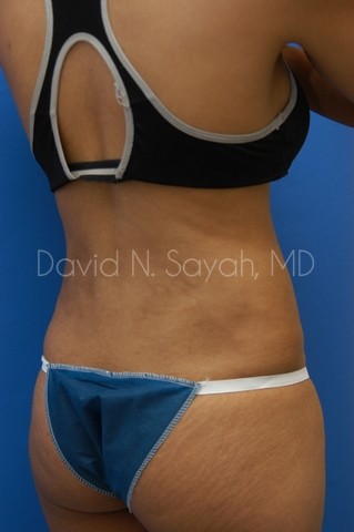 Liposuction Before and After | Sayah Institute