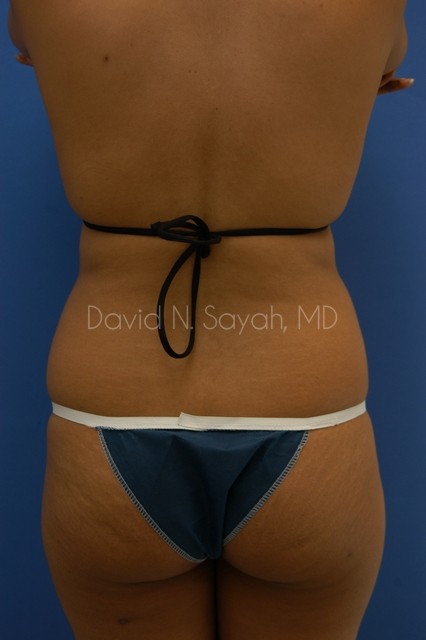 Liposuction Before and After | Sayah Institute