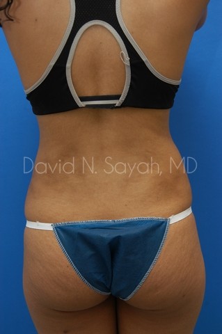 Liposuction Before and After | Sayah Institute