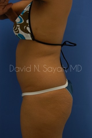 Liposuction Before and After | Sayah Institute