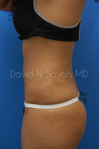 Liposuction Before and After | Sayah Institute