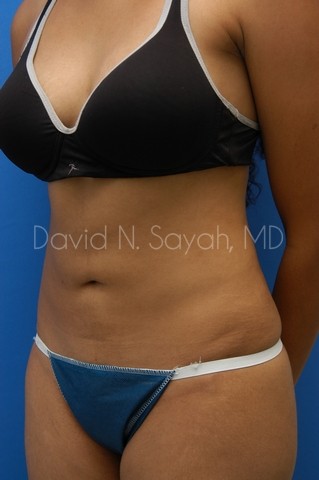 Liposuction Before and After | Sayah Institute