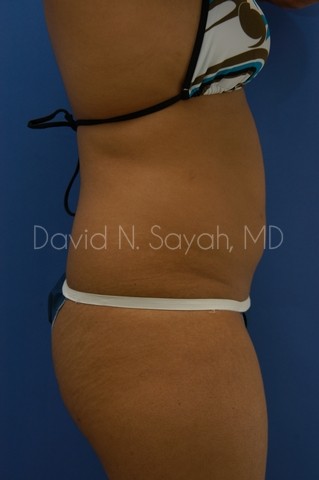 Liposuction Before and After | Sayah Institute