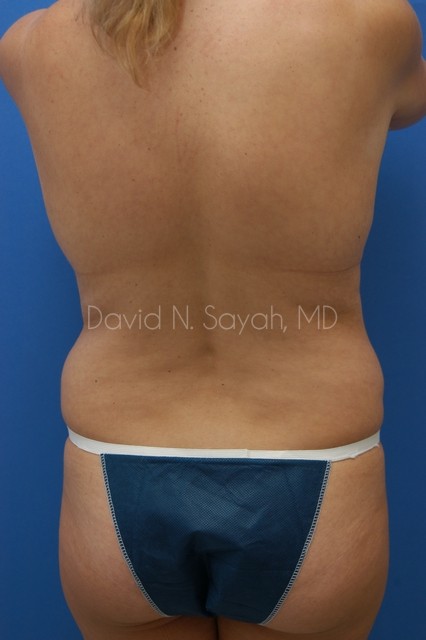 Liposuction Before and After | Sayah Institute