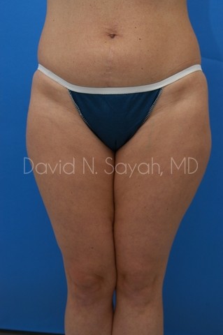 Liposuction Before and After | Sayah Institute