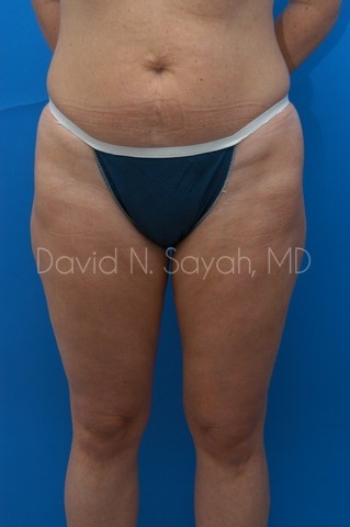 Liposuction Before and After | Sayah Institute