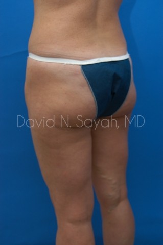 Liposuction Before and After | Sayah Institute