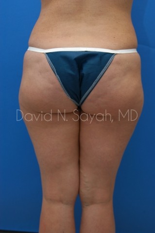 Liposuction Before and After | Sayah Institute