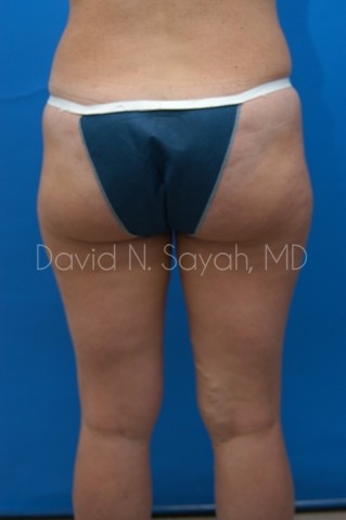 Liposuction Before and After | Sayah Institute