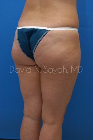 Liposuction Before and After | Sayah Institute