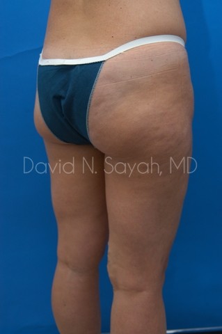 Liposuction Before and After | Sayah Institute