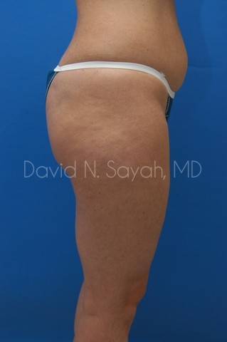 Liposuction Before and After | Sayah Institute