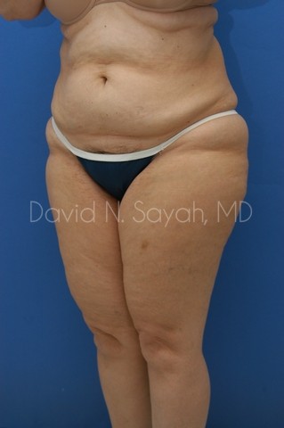 Liposuction Before and After | Sayah Institute