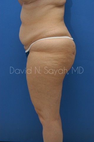 Liposuction Before and After | Sayah Institute