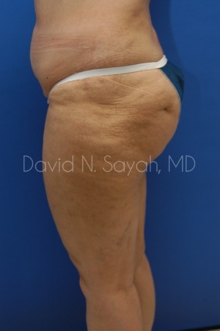 Liposuction Before and After | Sayah Institute