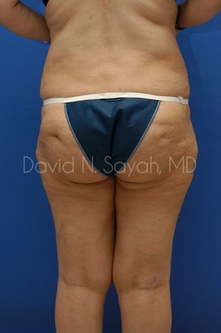 Liposuction Before and After | Sayah Institute