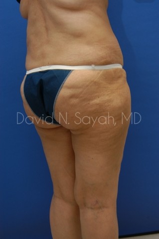 Liposuction Before and After | Sayah Institute