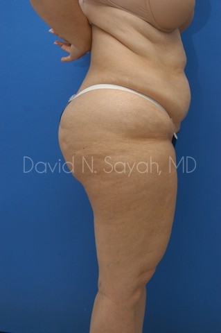 Liposuction Before and After | Sayah Institute