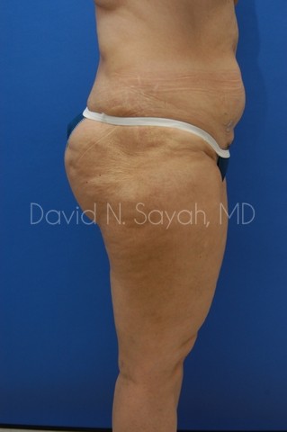 Liposuction Before and After | Sayah Institute