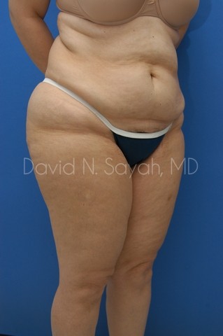 Liposuction Before and After | Sayah Institute