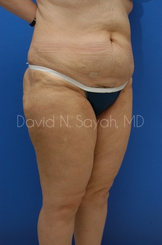 Liposuction Before and After | Sayah Institute