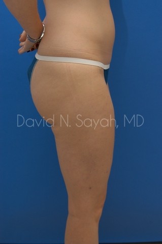 Liposuction Before and After | Sayah Institute