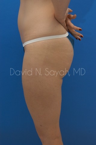 Liposuction Before and After | Sayah Institute