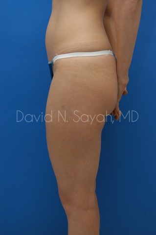 Liposuction Before and After | Sayah Institute