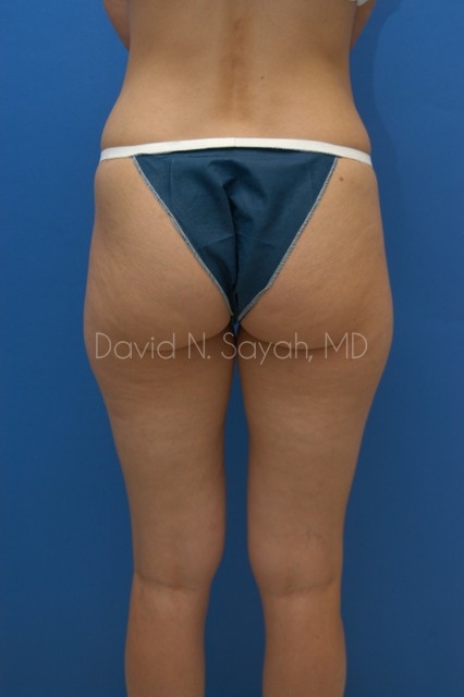 Liposuction Before and After | Sayah Institute