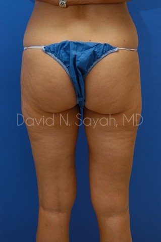 Liposuction Before and After | Sayah Institute