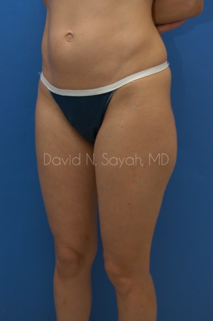 Liposuction Before and After | Sayah Institute