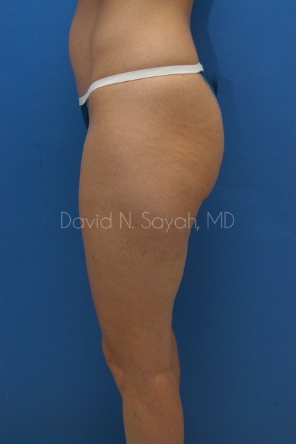 Liposuction Before and After | Sayah Institute