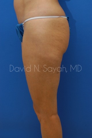 Liposuction Before and After | Sayah Institute