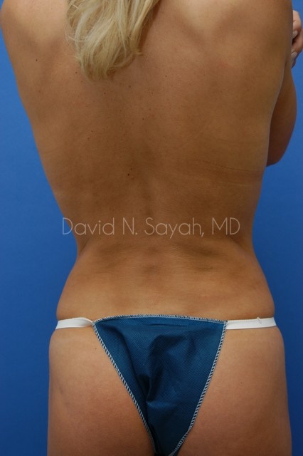 Liposuction Before and After | Sayah Institute