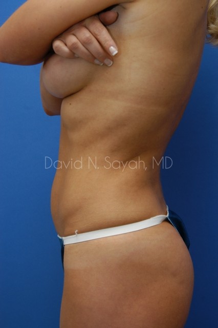 Liposuction Before and After | Sayah Institute