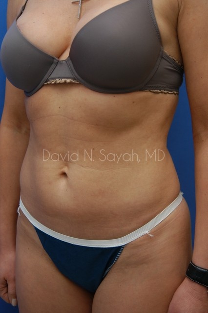 Liposuction Before and After | Sayah Institute