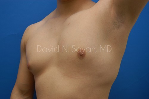 Male Breast Surgery Before and After | Sayah Institute