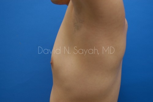 Male Breast Surgery Before and After | Sayah Institute
