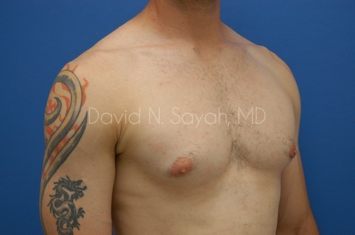 Male Breast Surgery Before and After | Sayah Institute