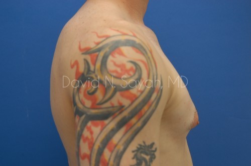 Male Breast Surgery Before and After | Sayah Institute