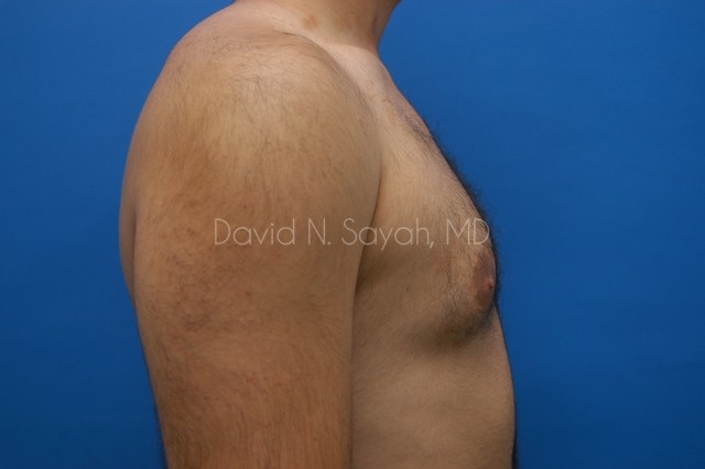 Male Breast Surgery Before and After | Sayah Institute