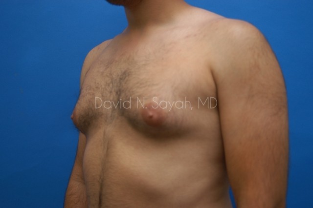 Male Breast Surgery Before and After | Sayah Institute