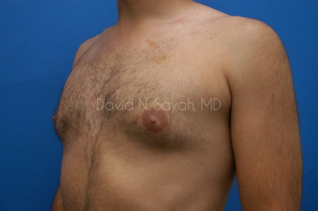 Male Breast Surgery Before and After | Sayah Institute