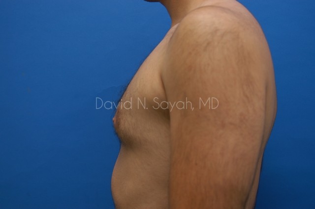 Male Breast Surgery Before and After | Sayah Institute