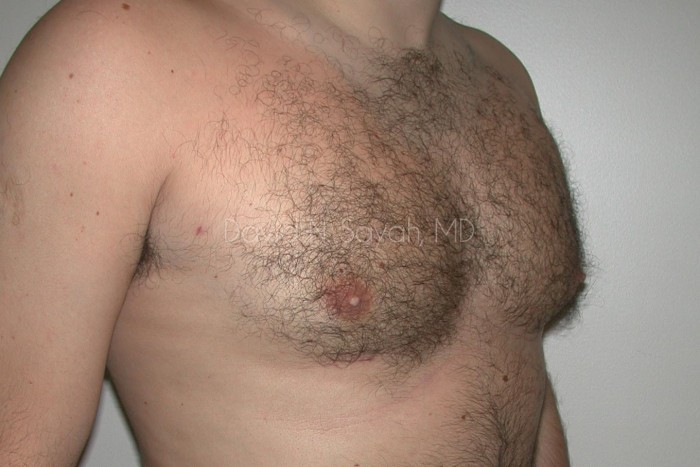 Male Breast Surgery Before and After | Sayah Institute