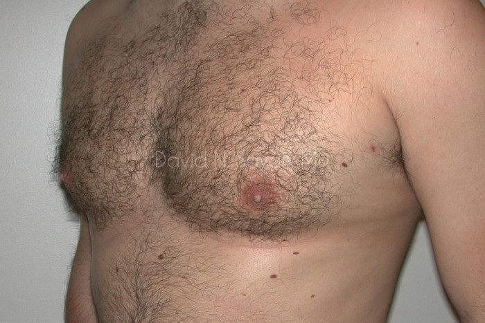 Male Breast Surgery Before and After | Sayah Institute